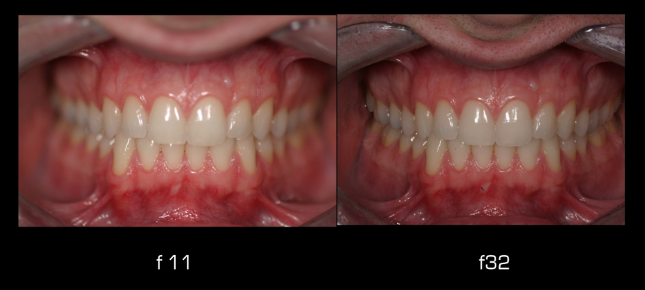 Aperture for dental photography